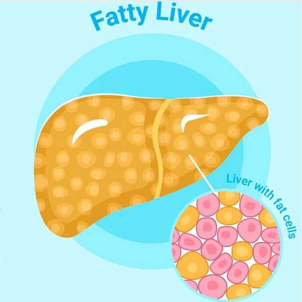 4 Daily Habits That Could Be Worsening Your Fatty Liver