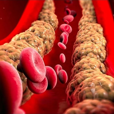 The Hidden Dangers of Elevated Triglycerides: Beyond Fatty Liver—Pancreatitis and Cardiovascular Disease at Risk