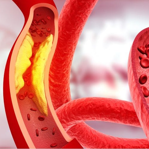 How to Prevent and Reduce Plaque in Blood Vessels